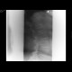 Compression fracture, second lumbar vertebra: X-ray - Plain radiograph